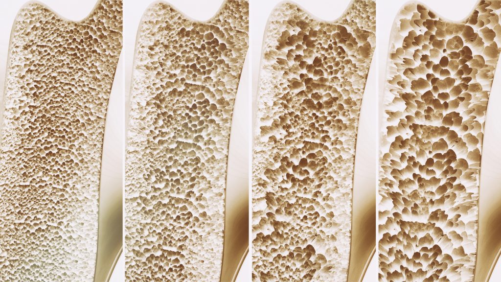 Osteoporosis in 4 stages 