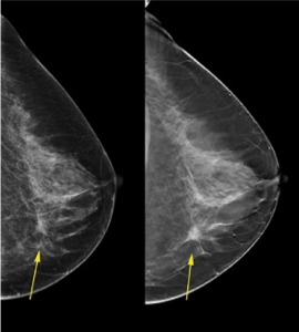 A comparison of 2D and 3D mammography.