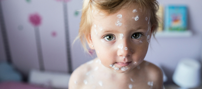 Child with chicken pox