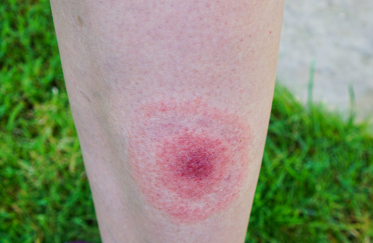 Lyme disease bulls-eye rash