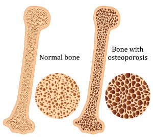 Normal bone and bone with osteoporosis