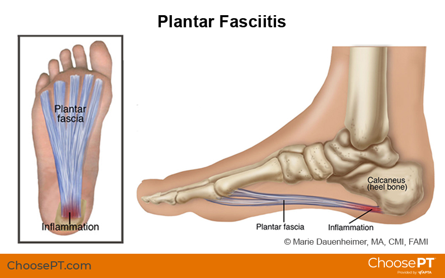 Physical or Occupational Therapy in Cleveland for Heel Pain - Plantar  Fasciitis