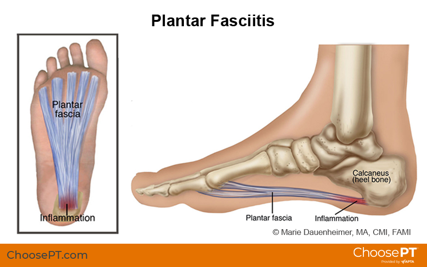 Plantar Fasciitis: Treatment, Symptoms, Causes, and More