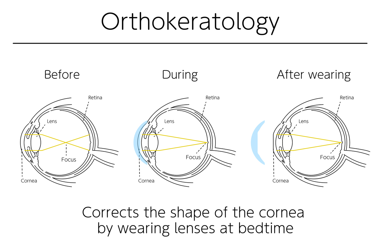 Medical illustration of the eye before, during and after wearing Ortho-K lenses.