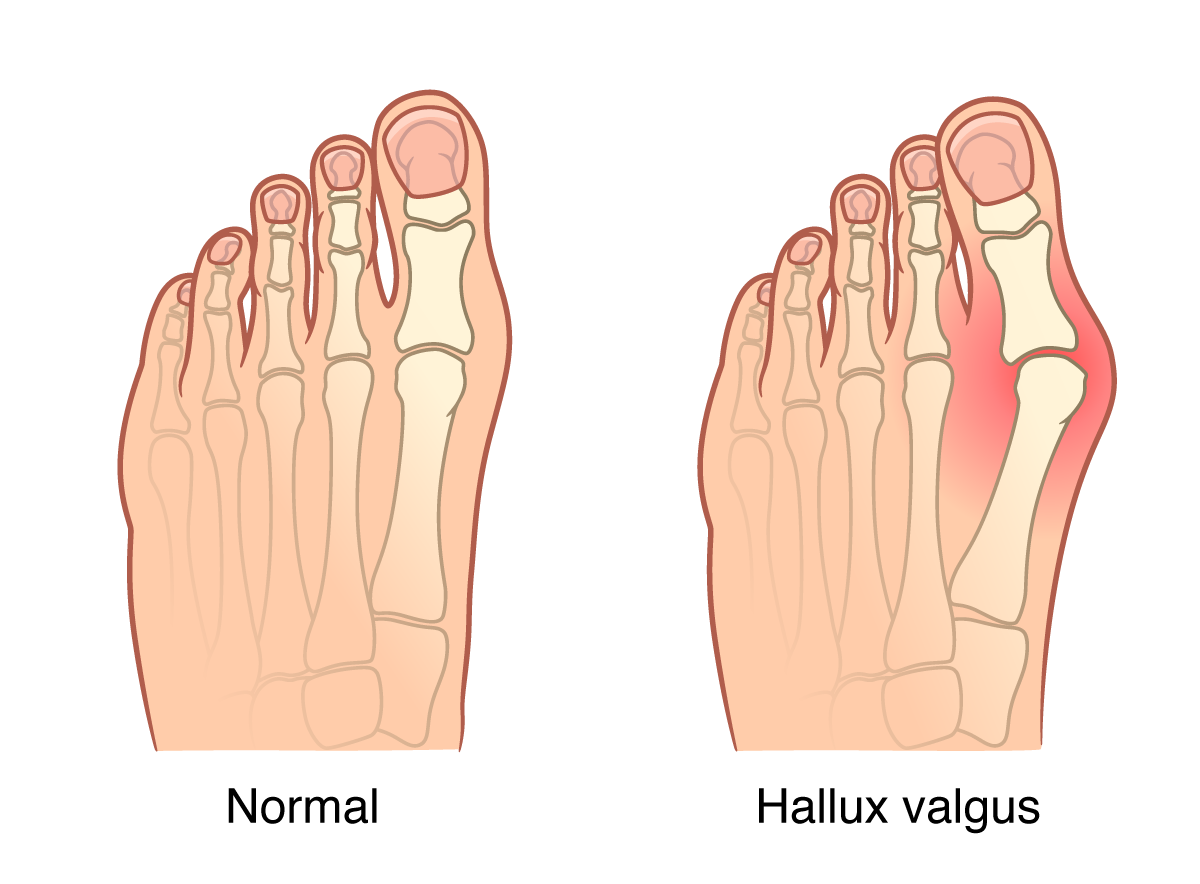 Medical illustration of normal foot and a foot with Hallus Valgus (a bunion)