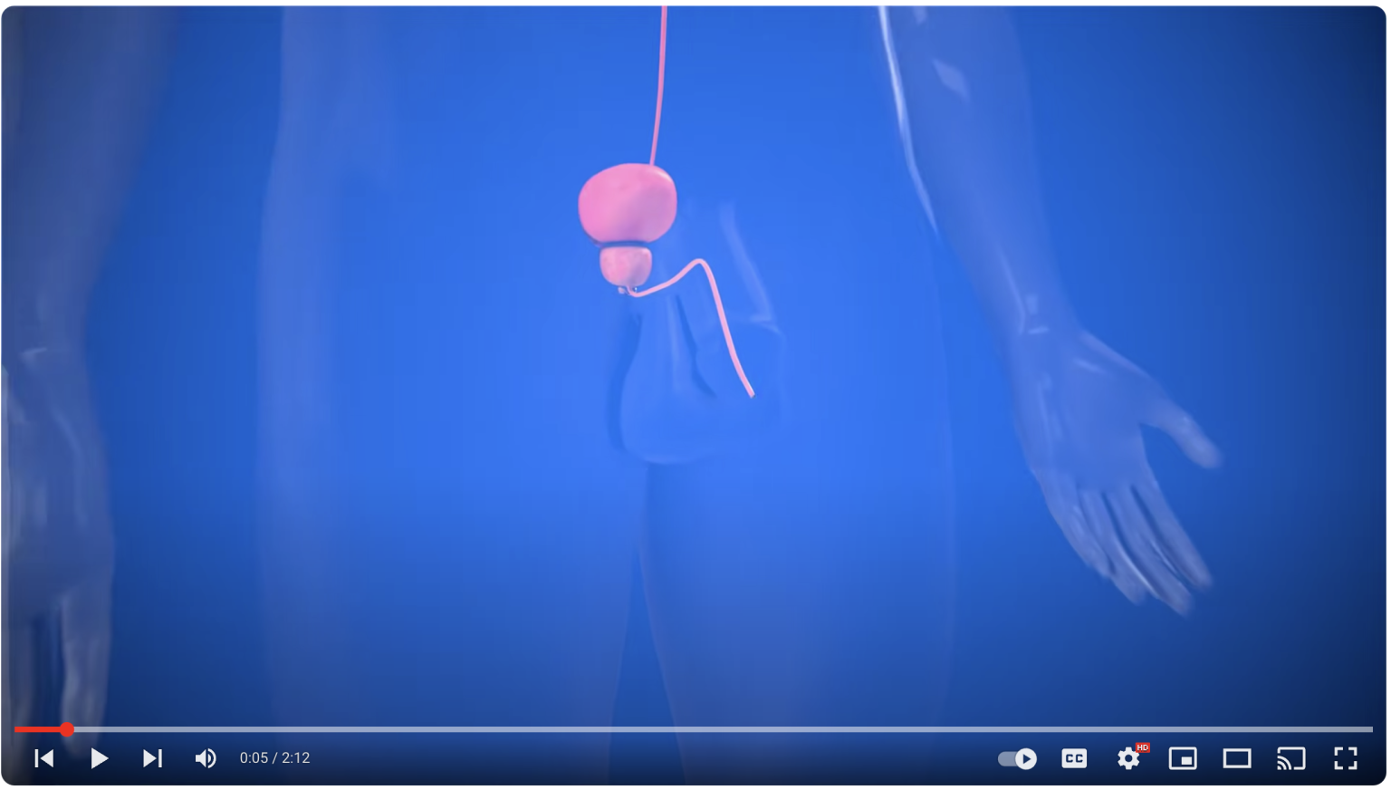 Spotlight on Men’s Health Understanding BPH Welia Health