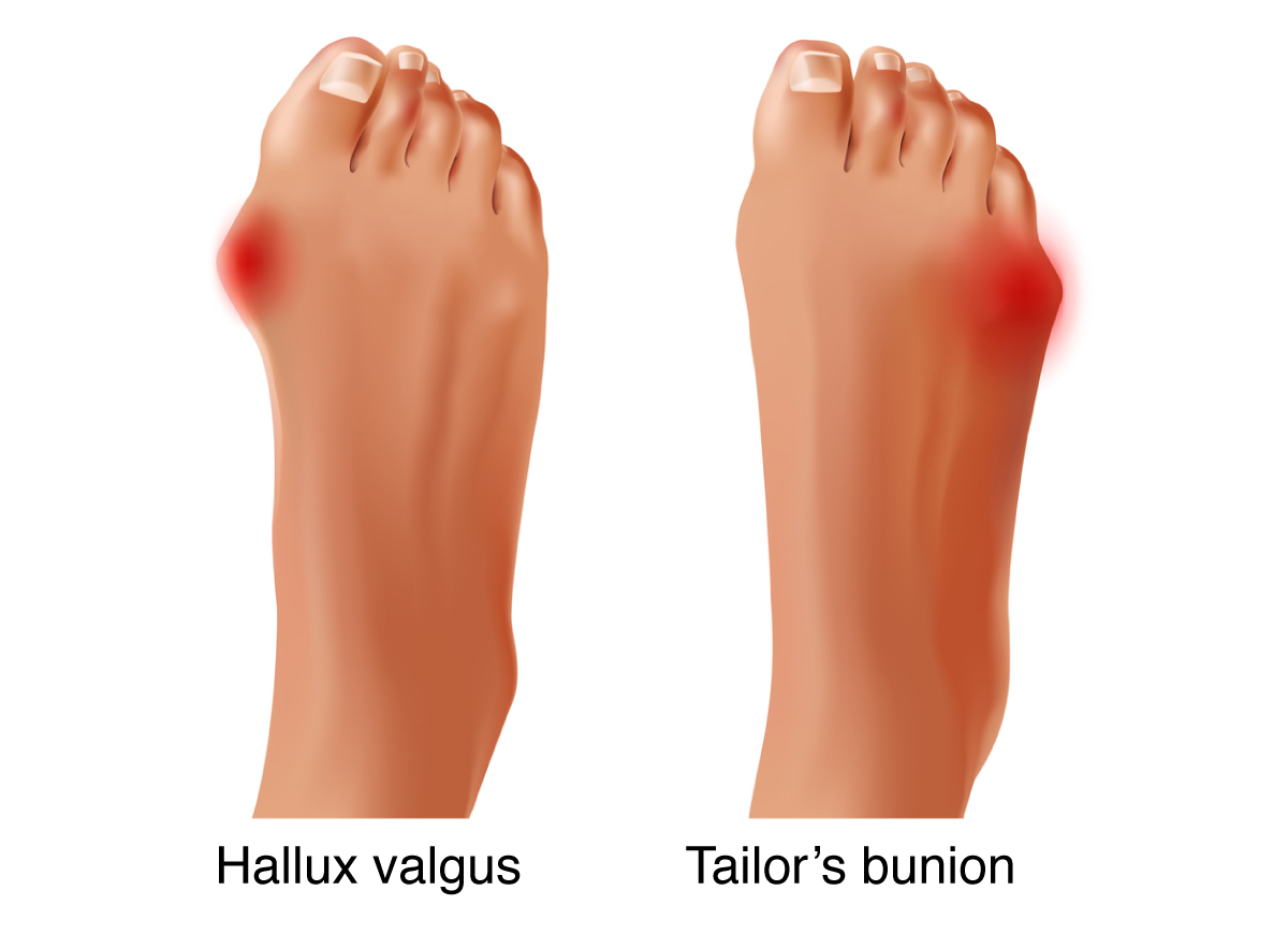 Medical illustration of bunions types: Hallus Valgus and Tailor's bunion.