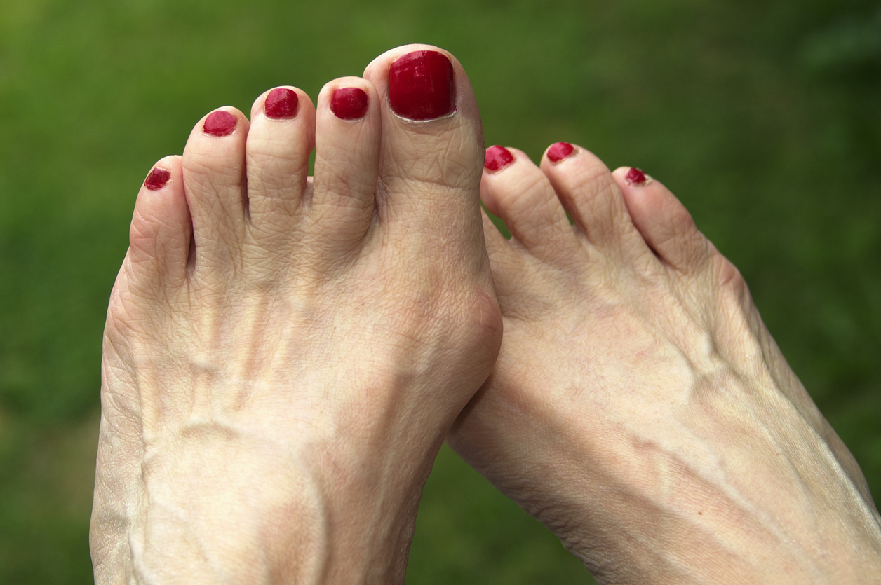 Bare feet with bunions, toenails painted red