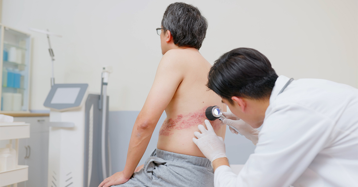 Man with shingles rash across his back being examined by a doctor