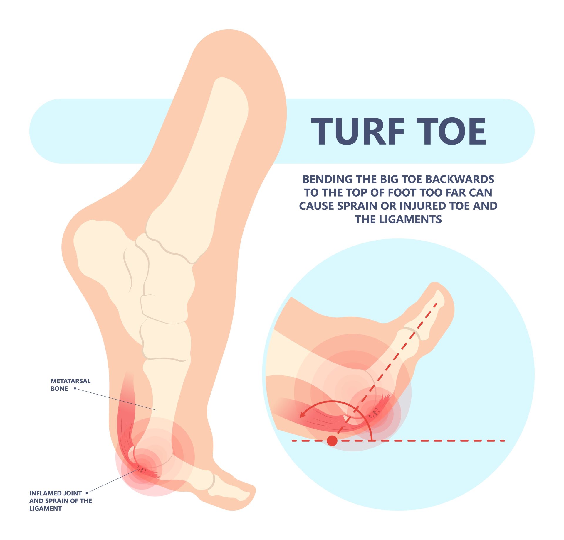 Medical illustration showing turf toe