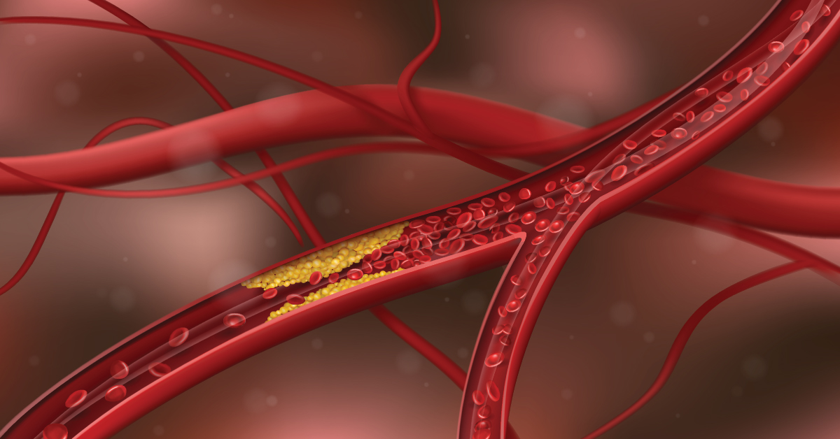 Close-up illustration of cholesterol accumulating in a blood vessel