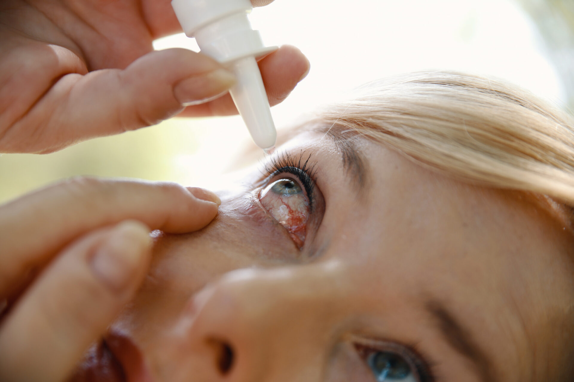Woman placing eye drops into a red, irritated eye
