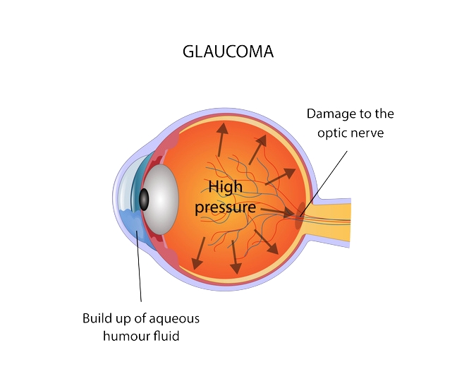 Eye with glaucoma, medical infographic with anatomy of the human eye